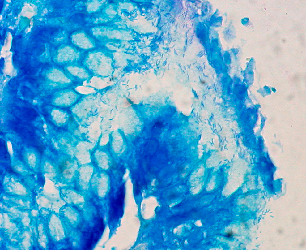 Detección de la bacteria Helicobacter Pylori Detección de la bacteria Helicobacter Pylori